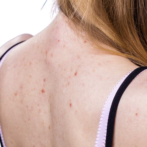 Rückakne — Was wirklich hilft und warum Peeling der erste Schritt ist