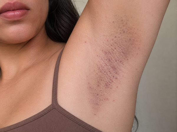 Eingewachsene Haare — Ursachen, Behandlung und warum Peeling der Schlüssel ist