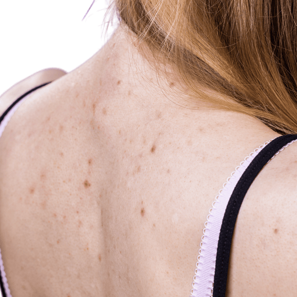 Cellulite, Körperakne und Erdbeerhaut — Was beim Peeling wirklich wirkt