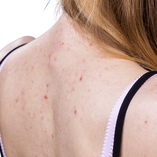 Rückakne — Was wirklich hilft und warum Peeling der erste Schritt ist